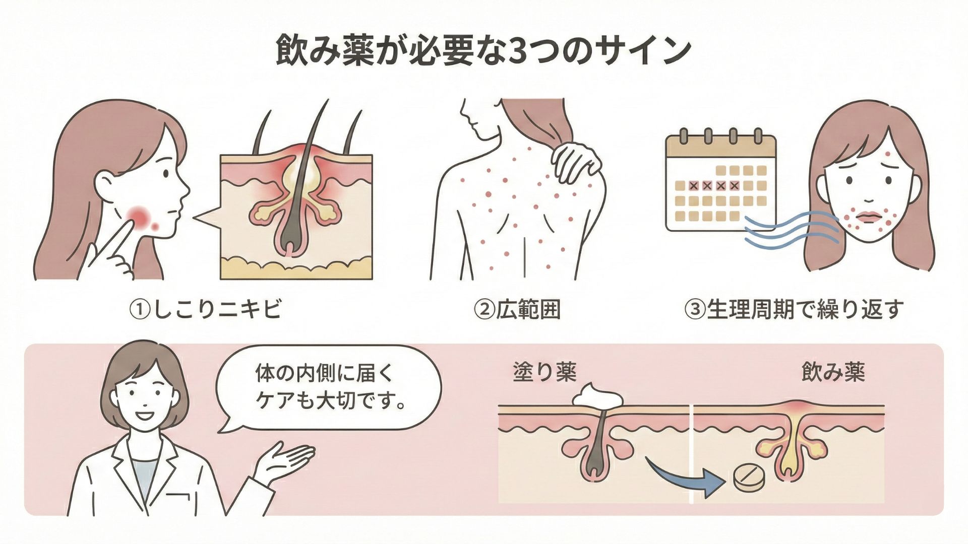 塗り薬だけじゃ治らない？飲み薬が必要な3つの判断基準